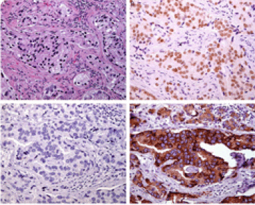 0314 0315 0317 anti-nkx3-1-metastatic-staining
